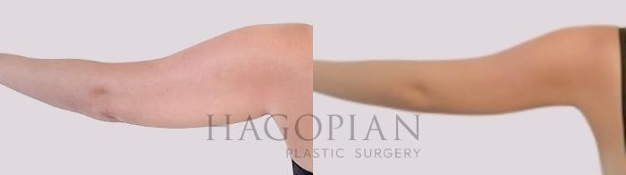 Before & After Skin Tightening Case 99 Back Left View in Atlanta, GA