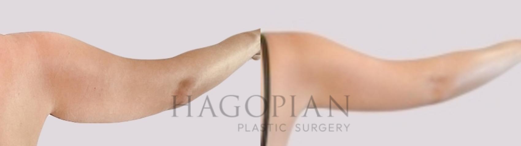 Before & After Skin Tightening Case 99 Back Right View in Atlanta, GA
