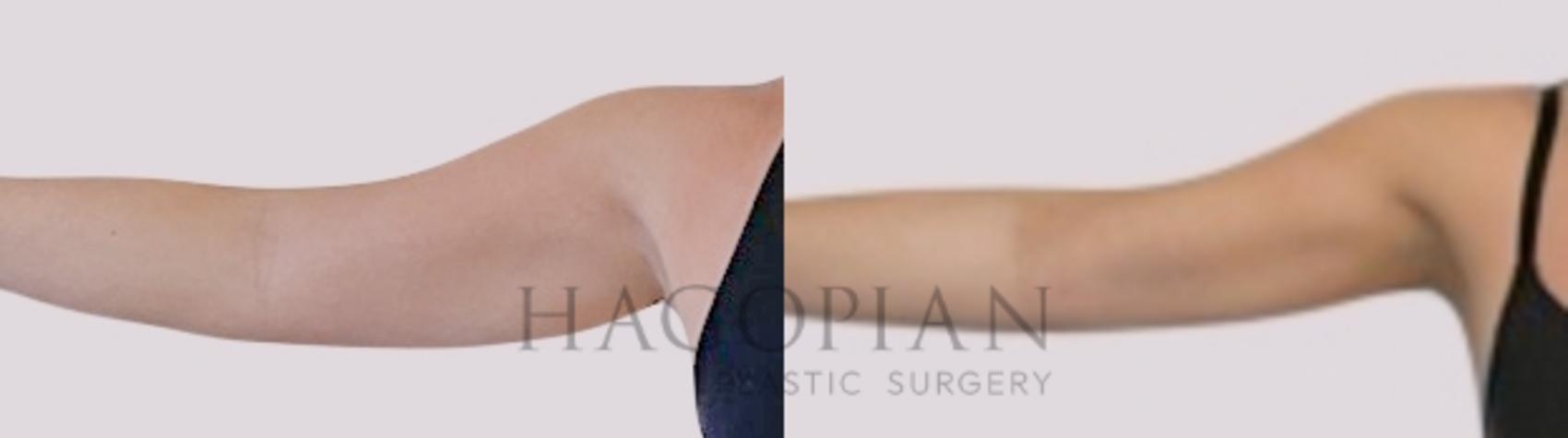 Before & After Skin Tightening Case 99 Front Left View in Atlanta, GA