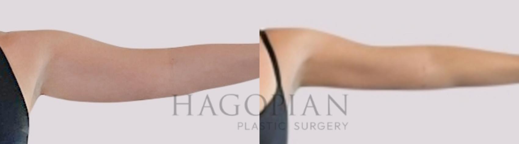Before & After Skin Tightening Case 99 Front Right View in Atlanta, GA