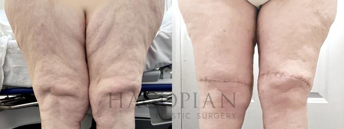 Before & After Thigh Lift Case 107 Front View in Atlanta, GA