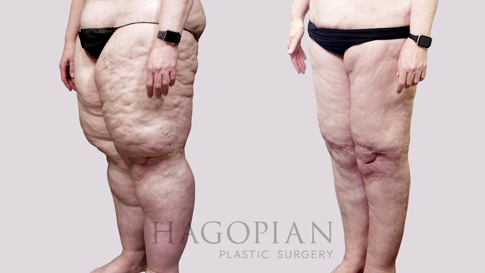 Before & After Thigh Lift Case 110 Left Oblique View in Atlanta, GA
