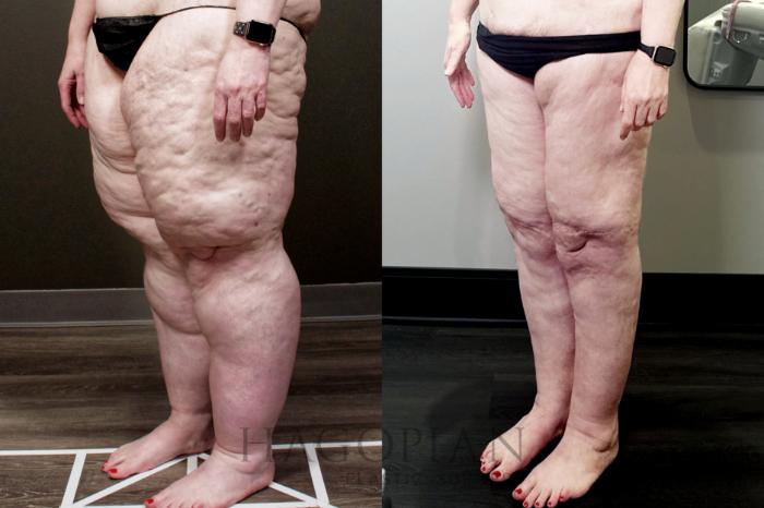 Before & After Thigh Lift Case 110 Left Oblique View in Atlanta, GA