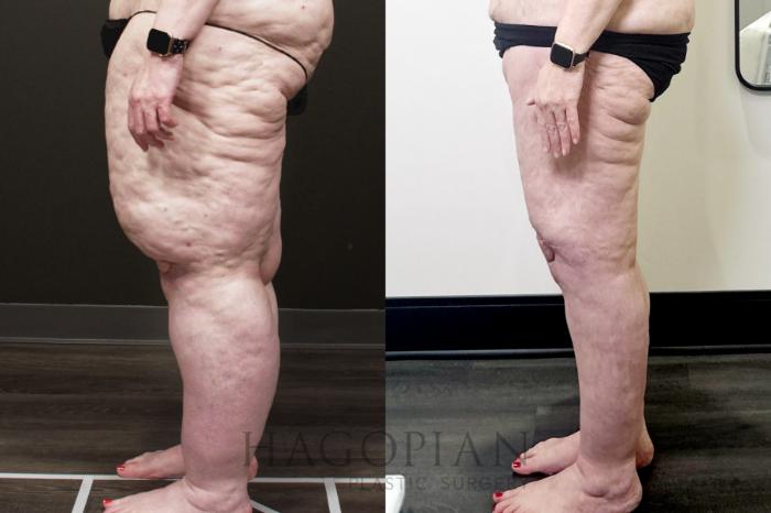 Before & After Thigh Lift Case 110 Left Side View in Atlanta, GA