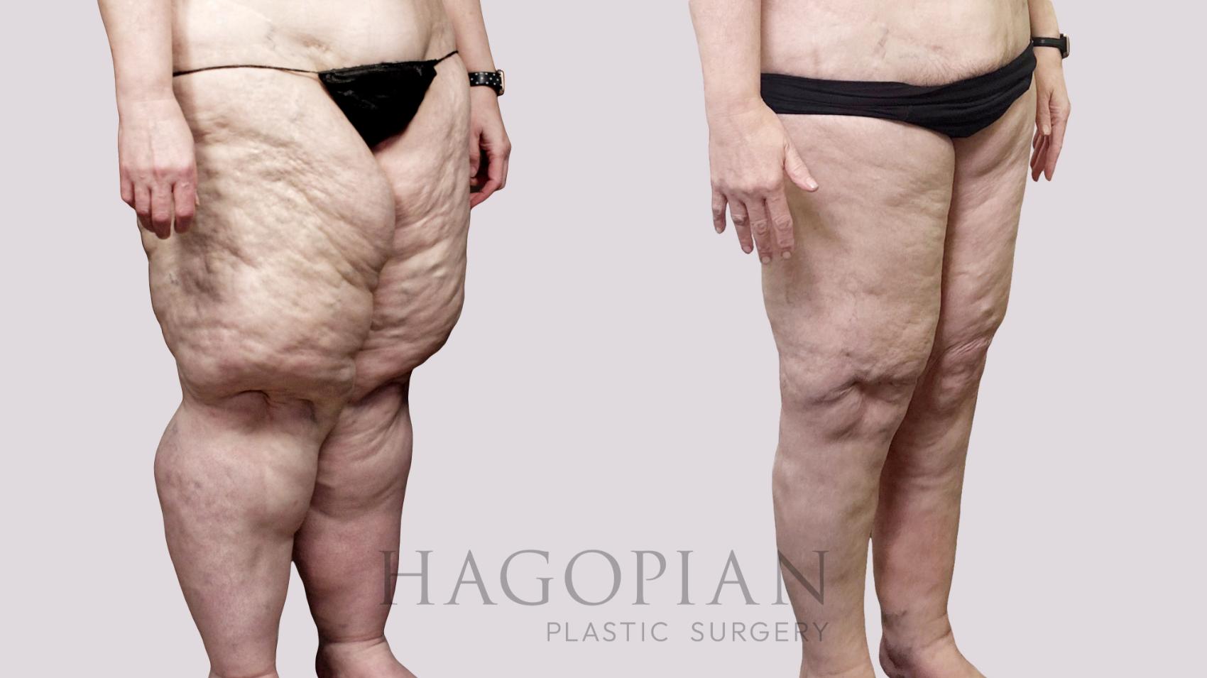 Before & After Thigh Lift Case 110 Right Oblique View in Atlanta, GA