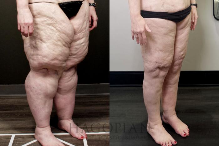 Before & After Thigh Lift Case 110 Right Oblique View in Atlanta, GA