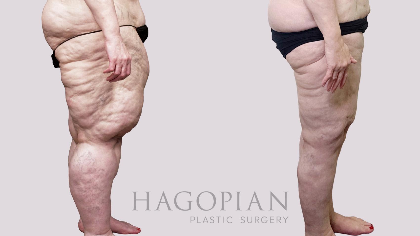 Before & After Thigh Lift Case 110 Right Side View in Atlanta, GA