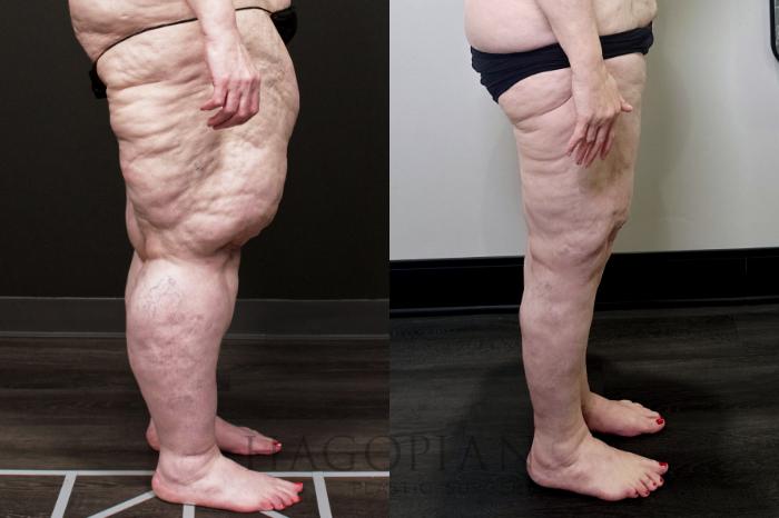 Before & After Thigh Lift Case 110 Right Side View in Atlanta, GA