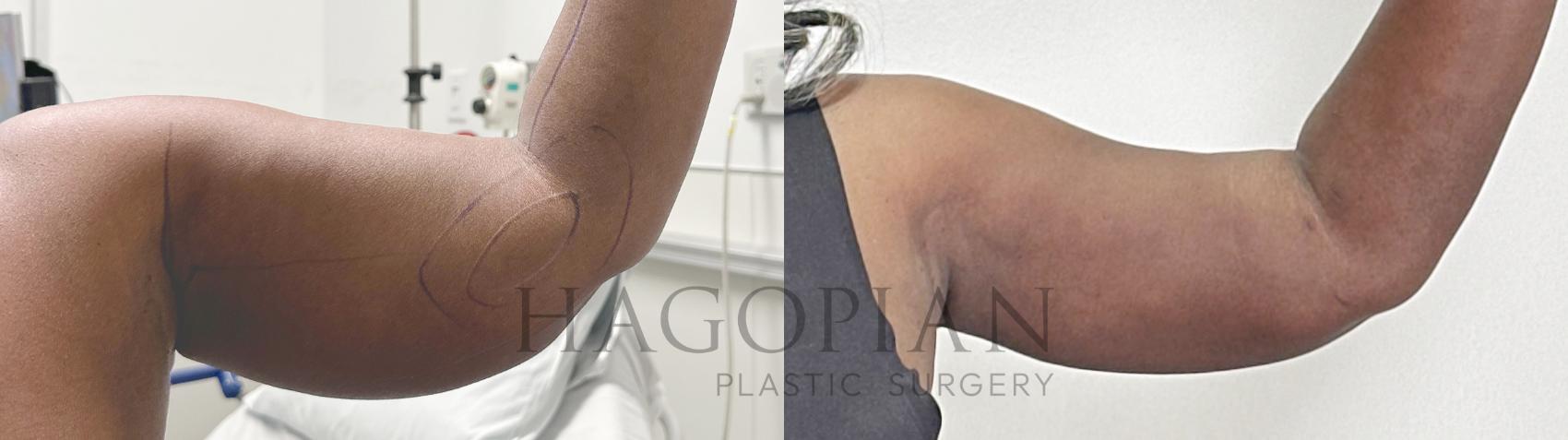 Before & After Thigh Lift Case 128 Left Side View in Atlanta, GA