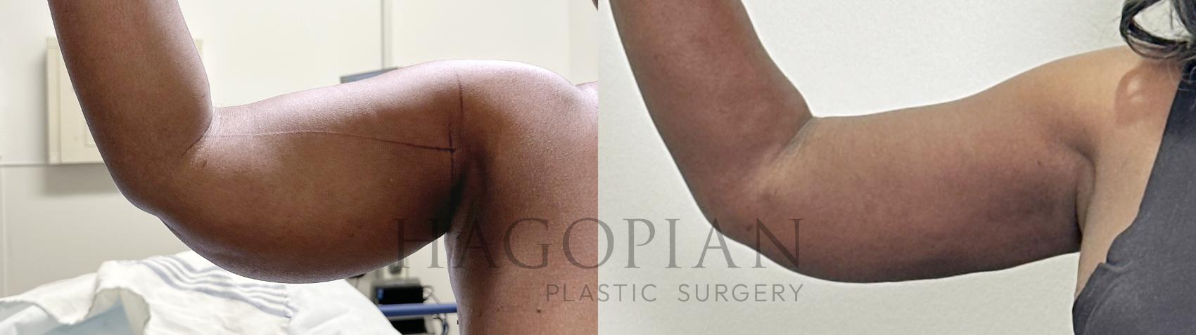 Before & After Thigh Lift Case 128 Right Side View in Atlanta, GA