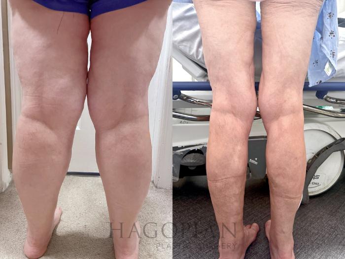 Before & After Thigh Lift Case 130 Back View in Atlanta, GA