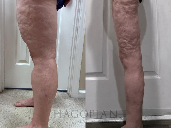 Before & After Thigh Lift Case 130 Left Side View in Atlanta, GA