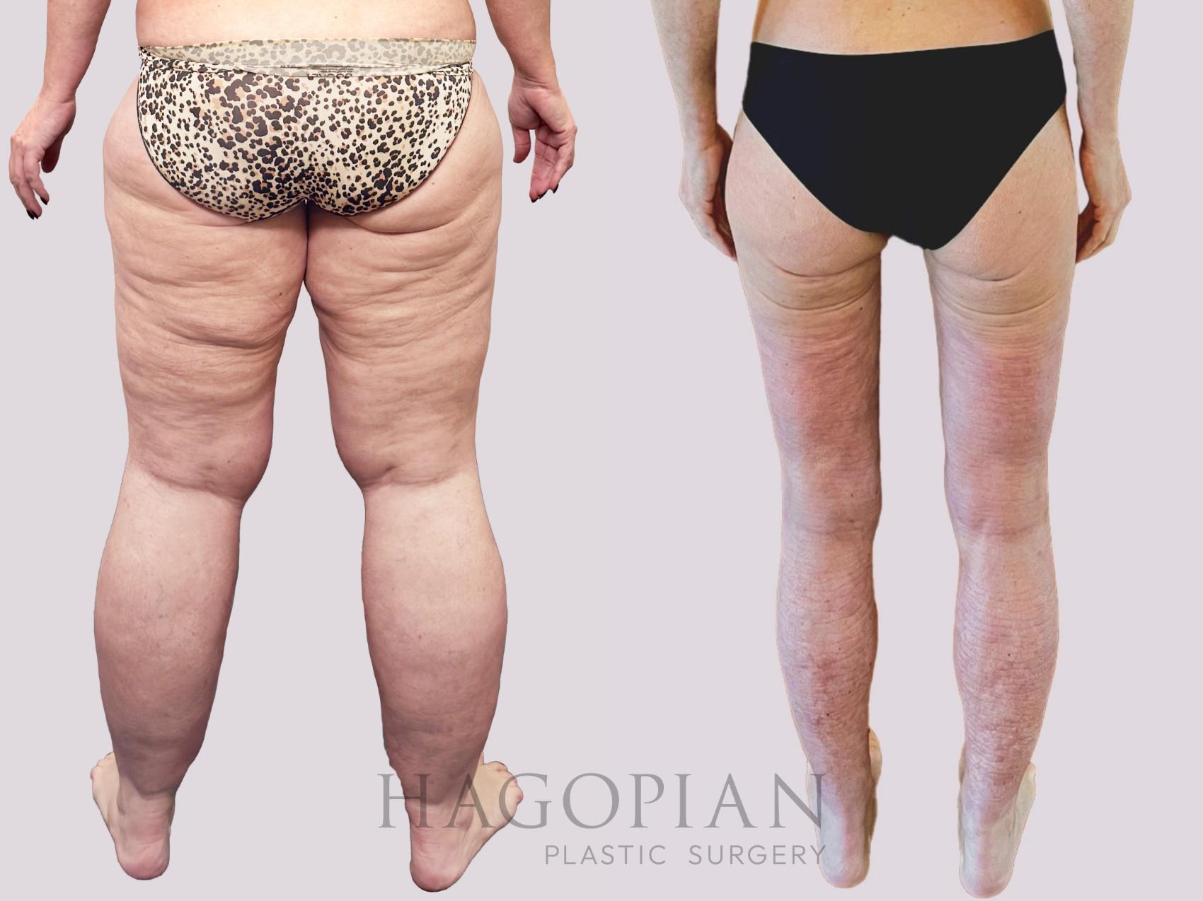Before & After Thigh Lift Case 156 Back View in Atlanta, GA
