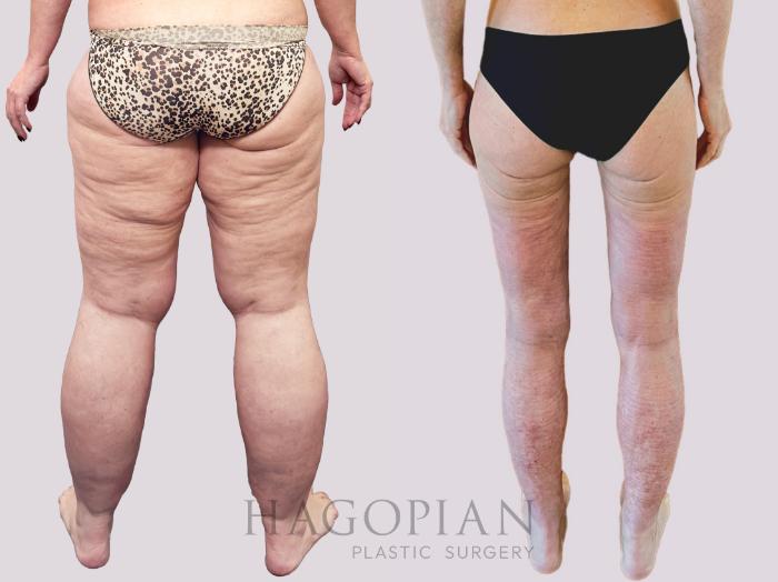 Before & After Thigh Lift Case 156 Back View in Atlanta, GA