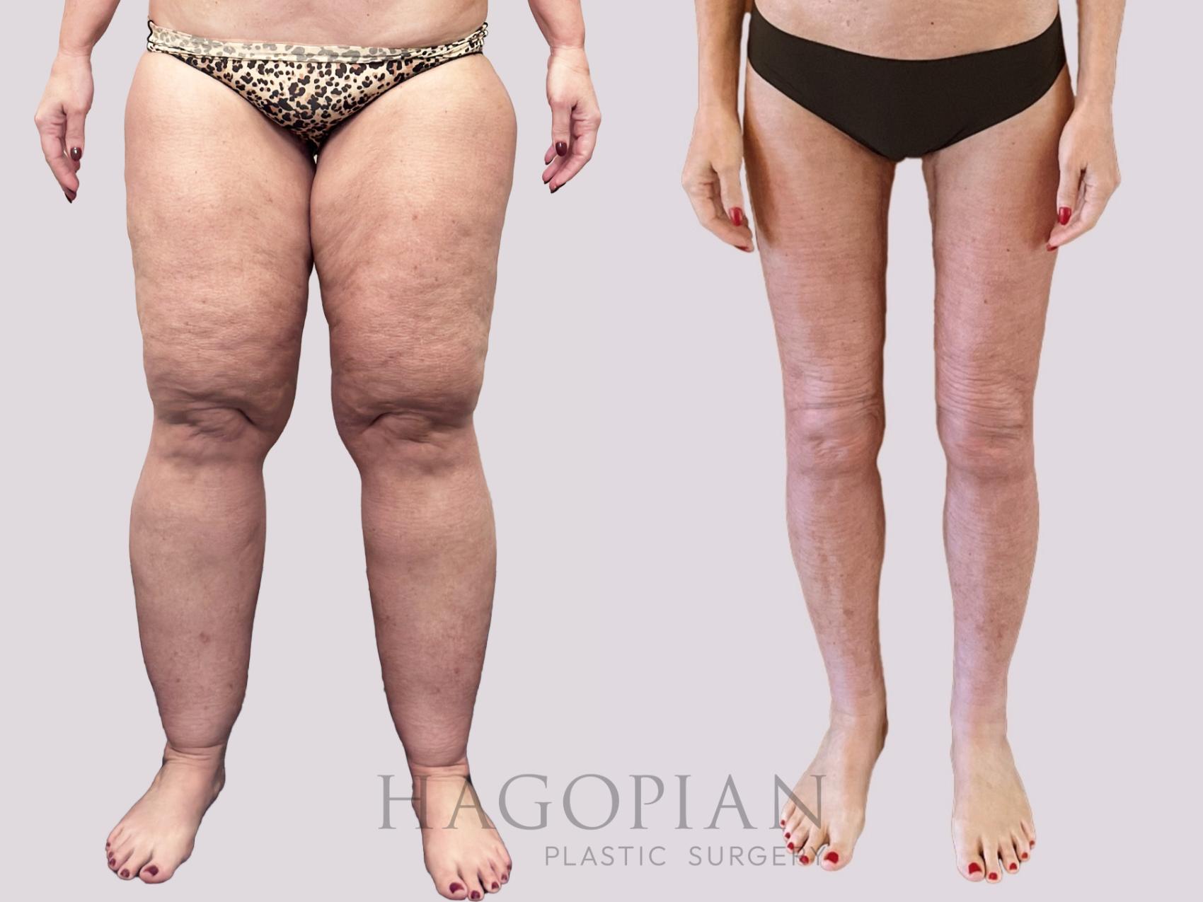 Before & After Thigh Lift Case 156 Front View in Atlanta, GA