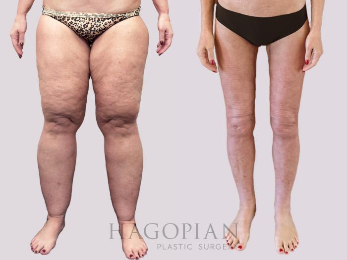 Before & After Thigh Lift Case 156 Front View in Atlanta, GA