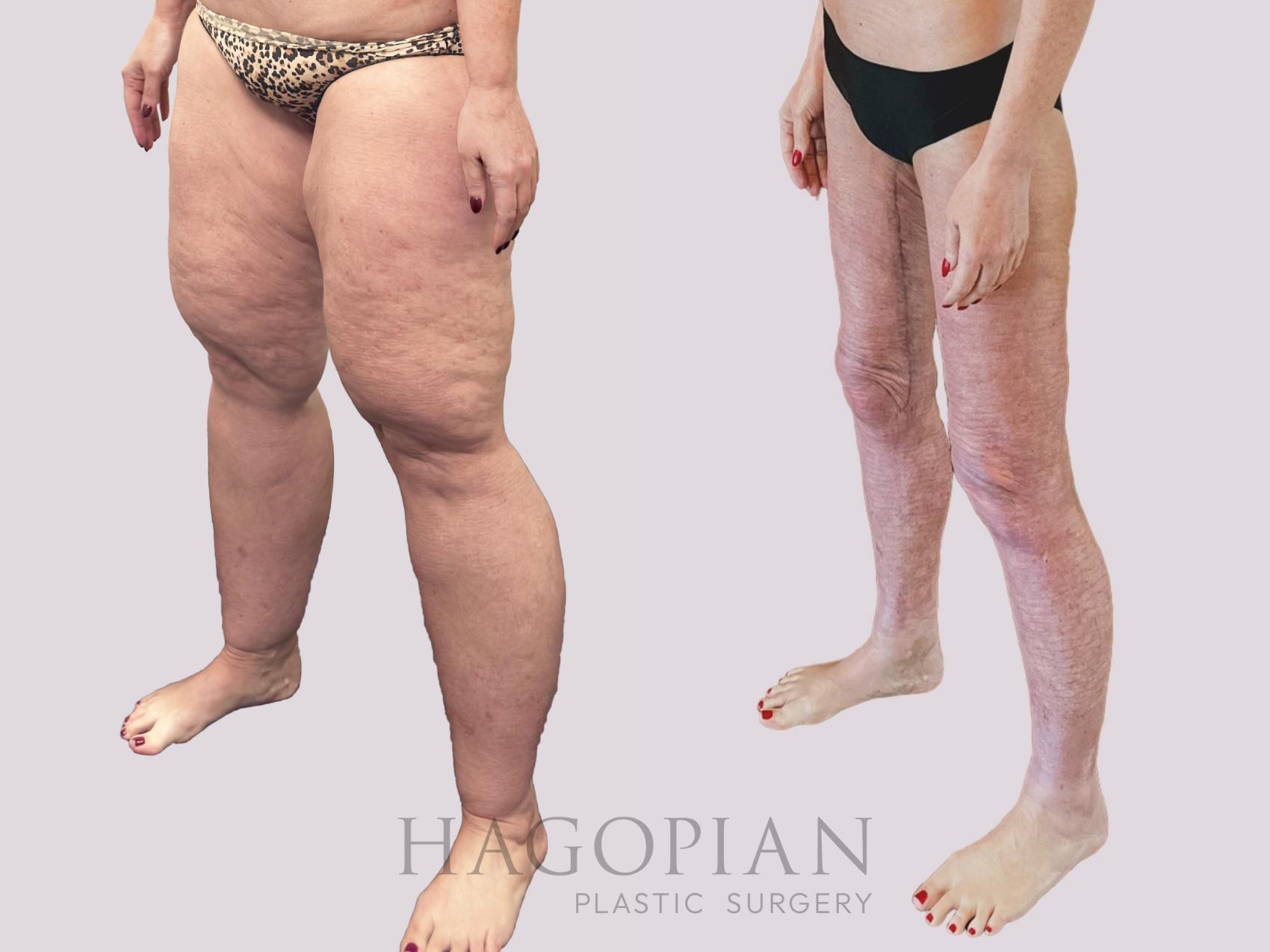 Before & After Thigh Lift Case 156 Left Oblique View in Atlanta, GA