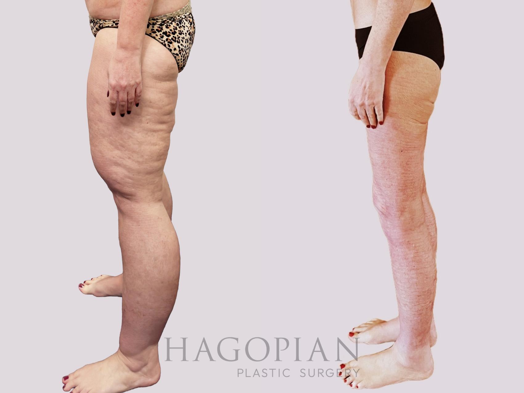 Before & After Thigh Lift Case 156 Left Side View in Atlanta, GA
