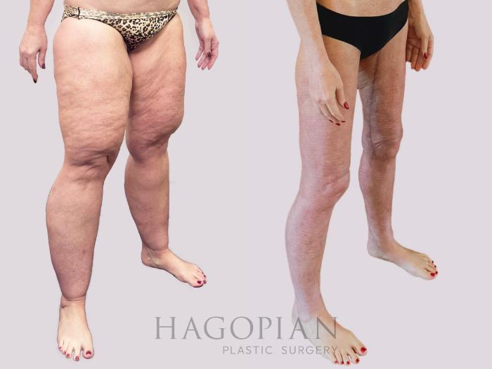Before & After Thigh Lift Case 156 Right Oblique View in Atlanta, GA