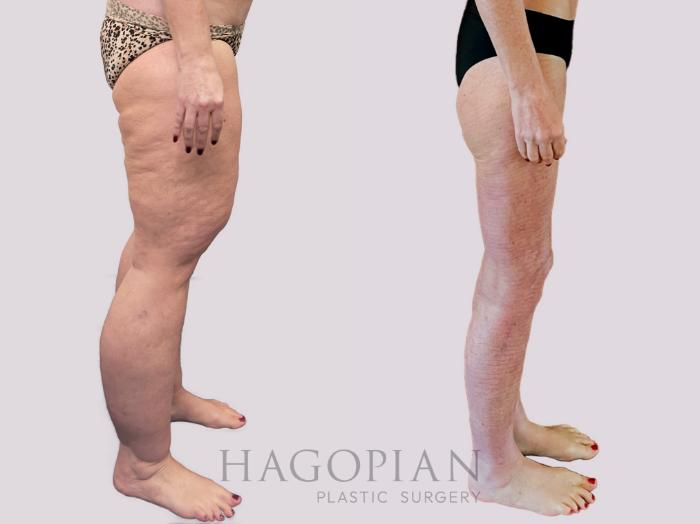 Before & After Thigh Lift Case 156 Right Side View in Atlanta, GA
