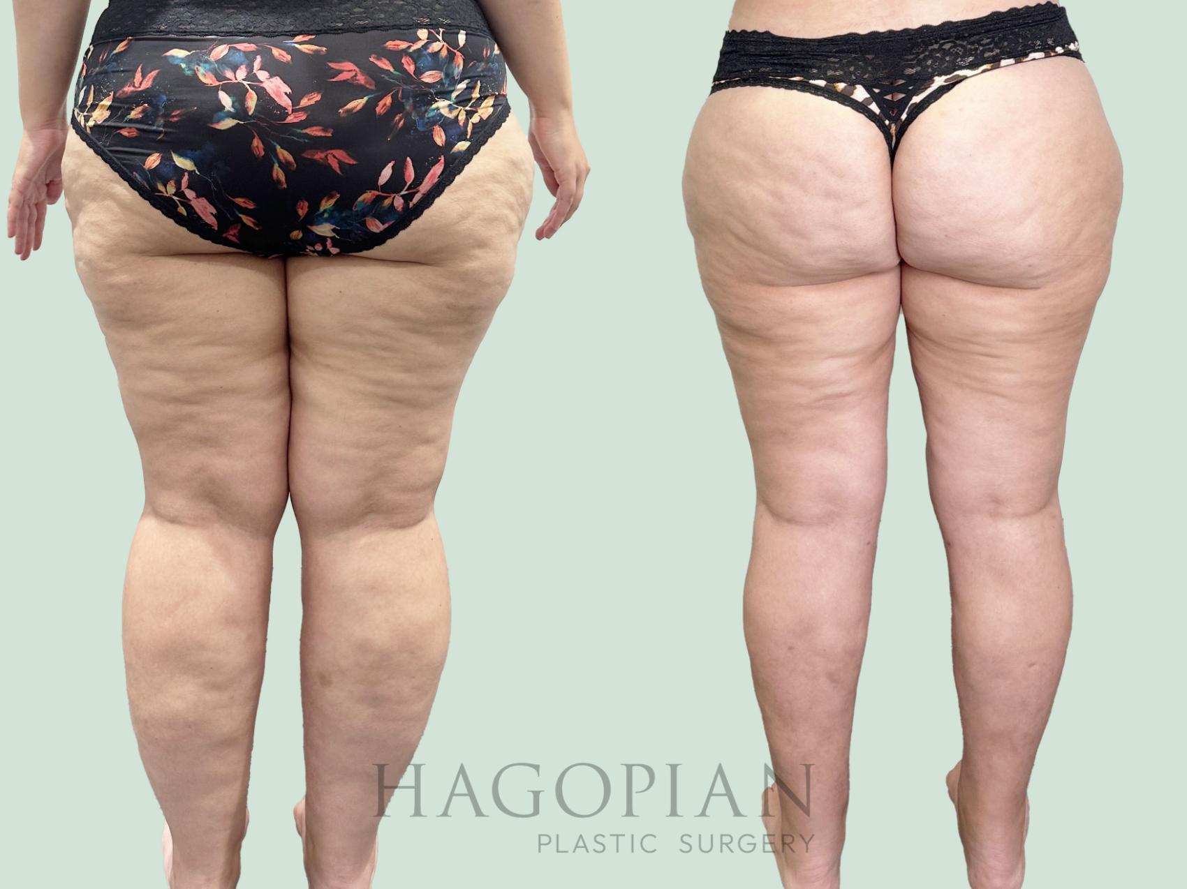 Before & After Thigh Lift Case 158 Back View in Atlanta, GA