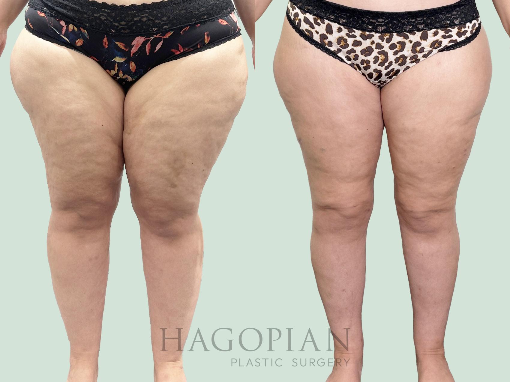 Before & After Thigh Lift Case 158 Front View in Atlanta, GA