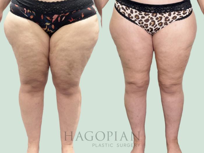 Before & After Thigh Lift Case 158 Front View in Atlanta, GA
