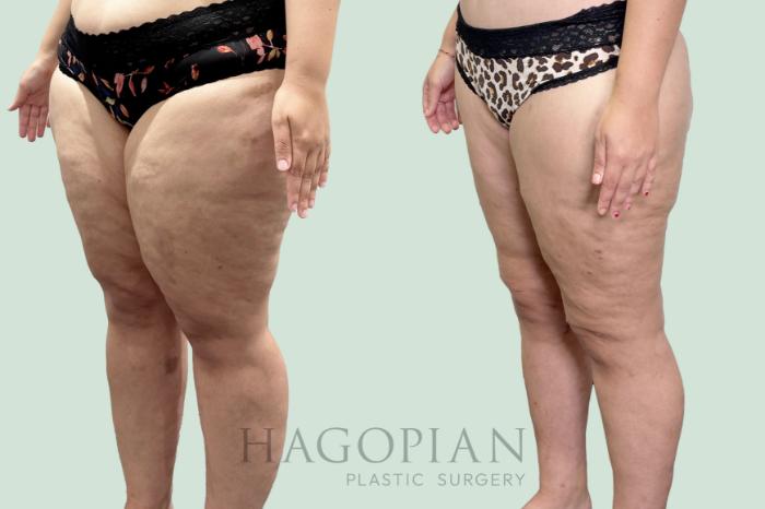 Before & After Thigh Lift Case 158 Left Oblique View in Atlanta, GA