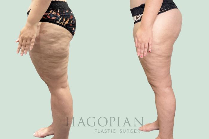 Before & After Thigh Lift Case 158 Left Side View in Atlanta, GA