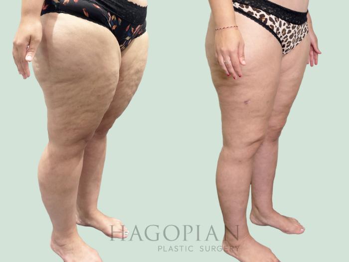 Before & After Thigh Lift Case 158 Right Oblique View in Atlanta, GA