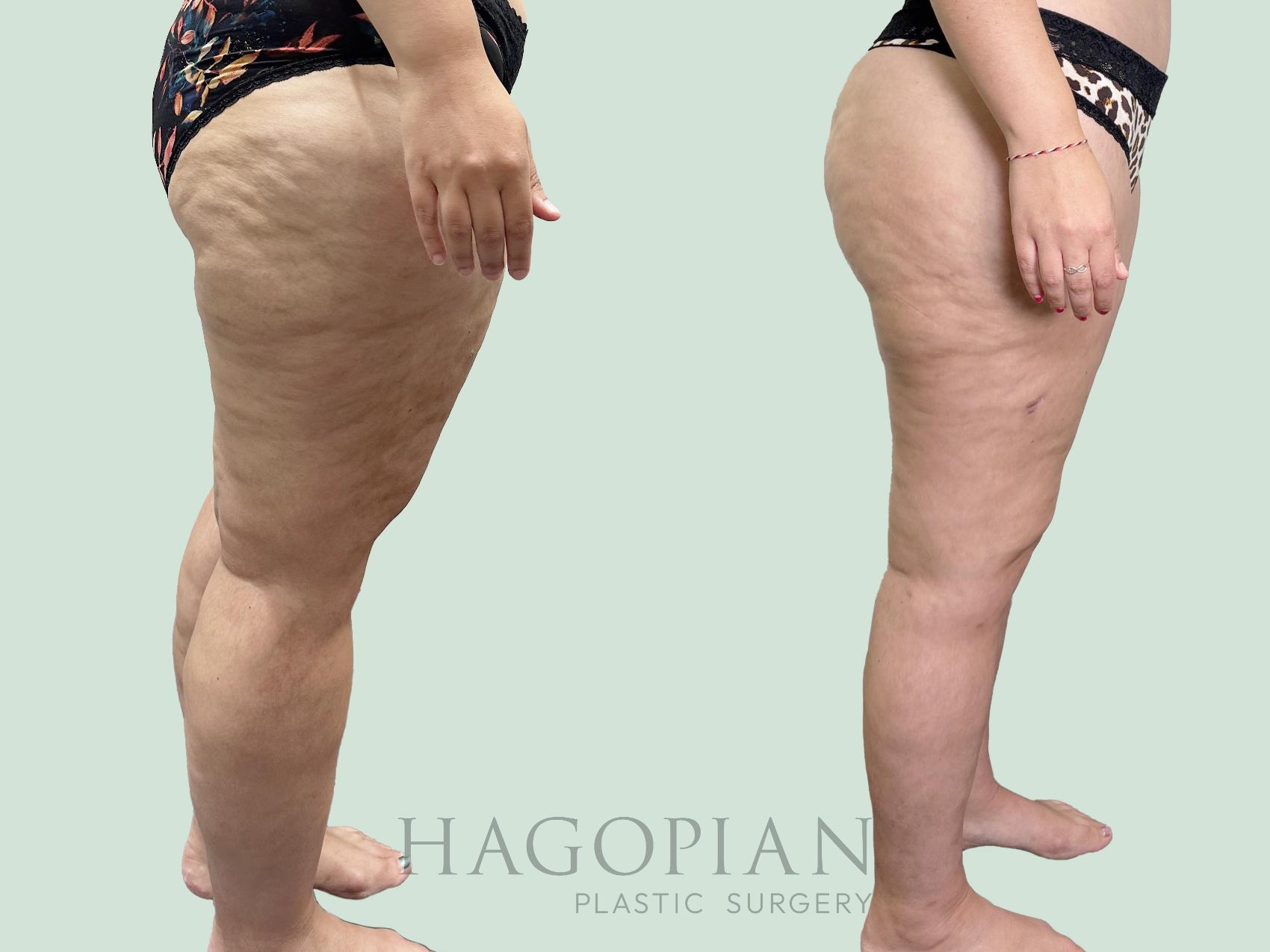 Before & After Thigh Lift Case 158 Right Side View in Atlanta, GA