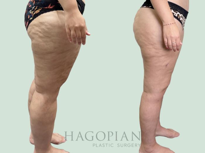 Before & After Thigh Lift Case 158 Right Side View in Atlanta, GA