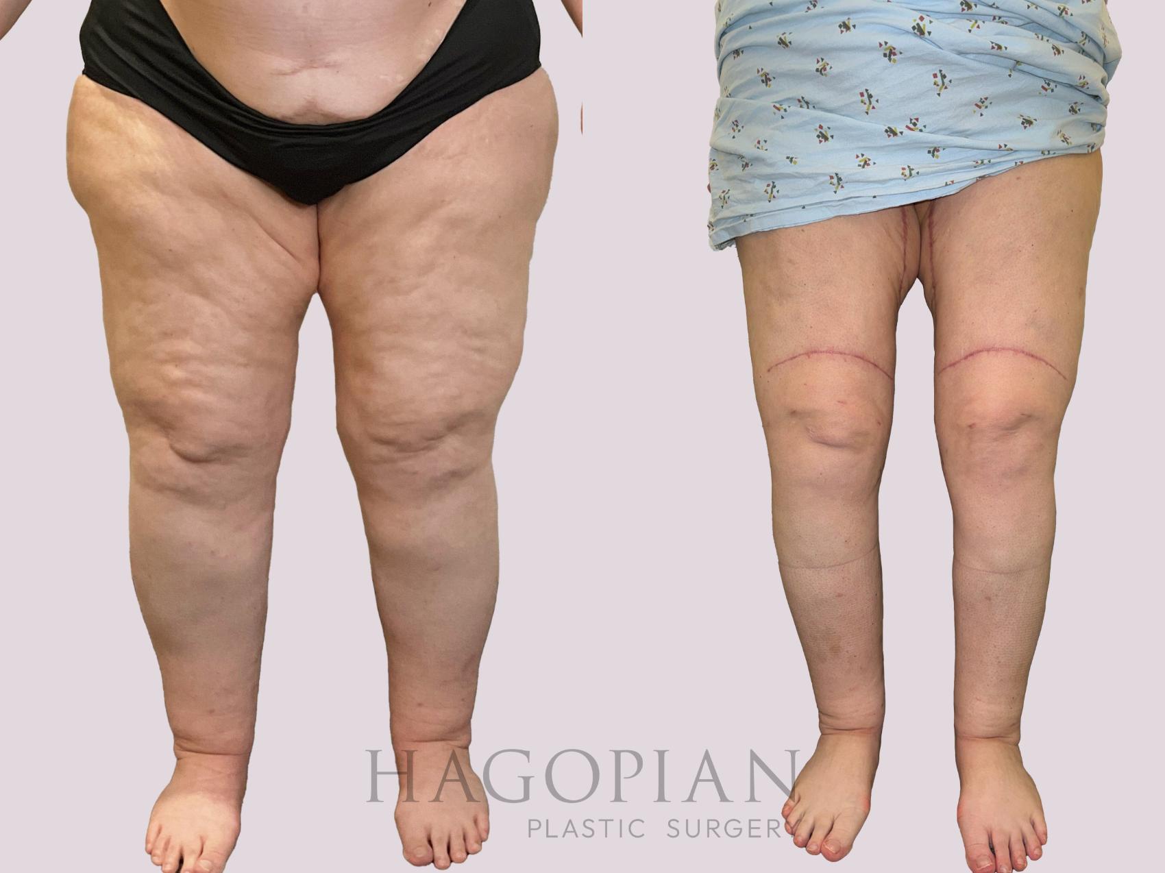 Before & After Thigh Lift Case 162 Front View in Atlanta, GA