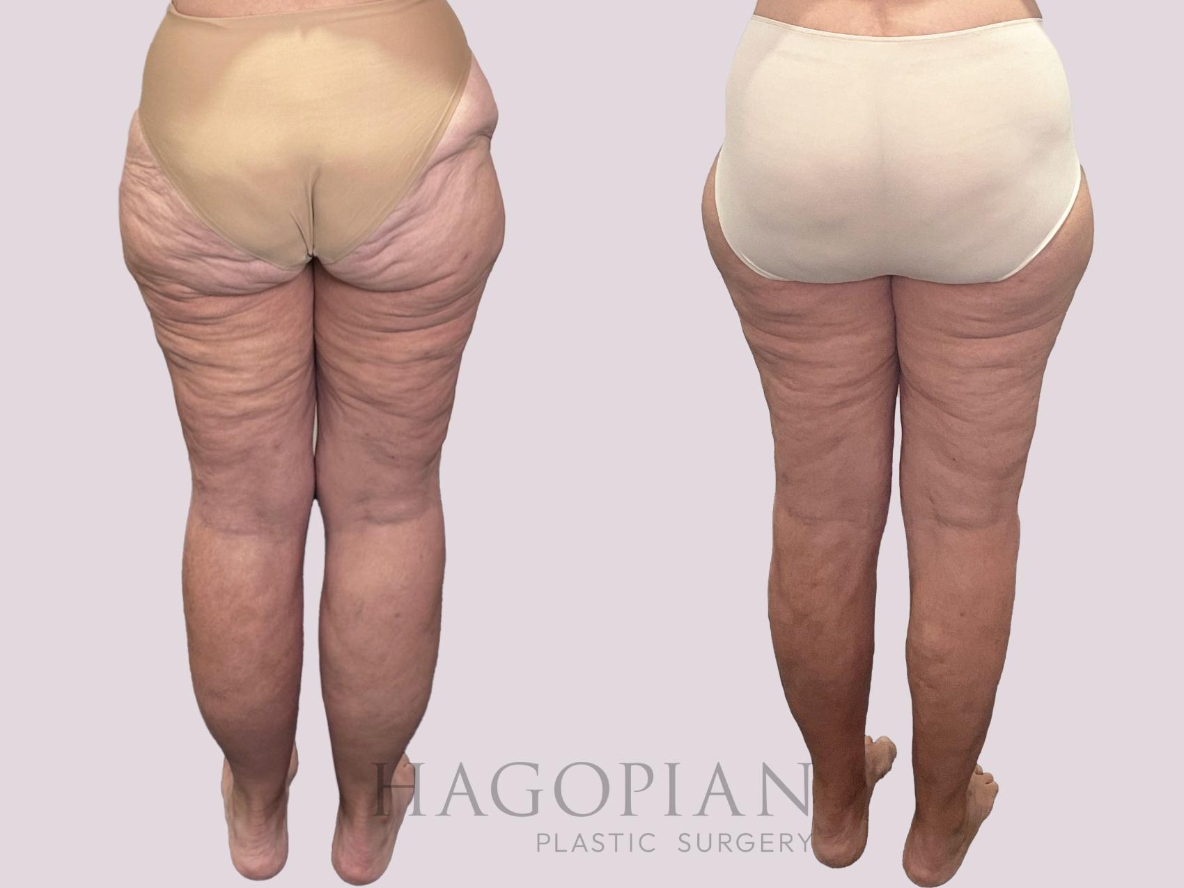 Before & After Thigh Lift Case 163 Back View in Atlanta, GA