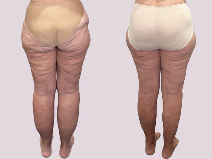 Before & After Thigh Lift Case 163 Back View in Atlanta, GA