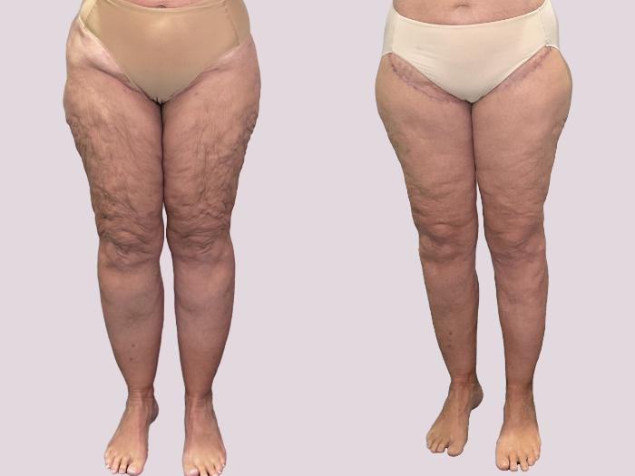 Before & After Thigh Lift Case 163 Front View in Atlanta, GA