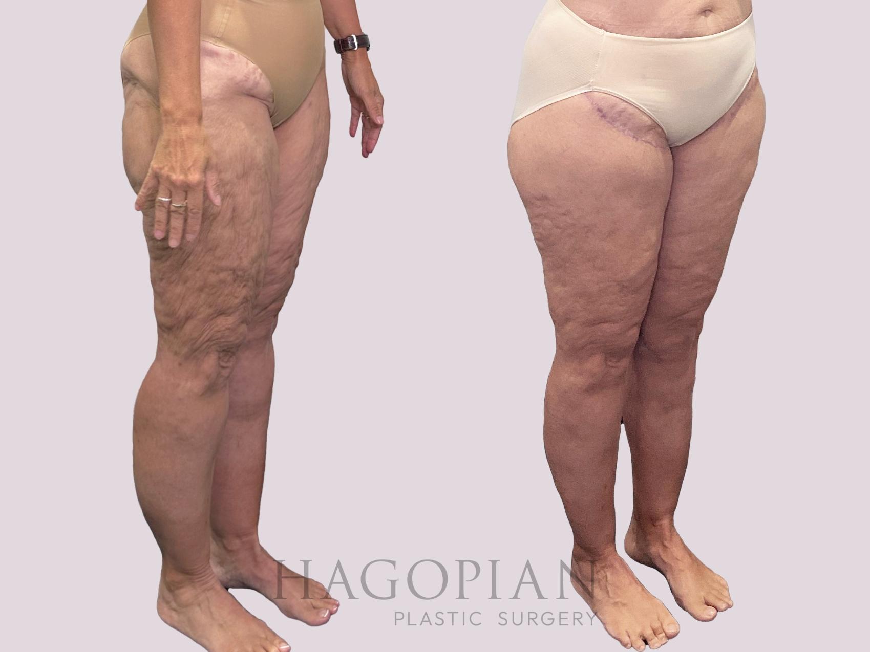 Before & After Thigh Lift Case 163 Right Oblique View in Atlanta, GA