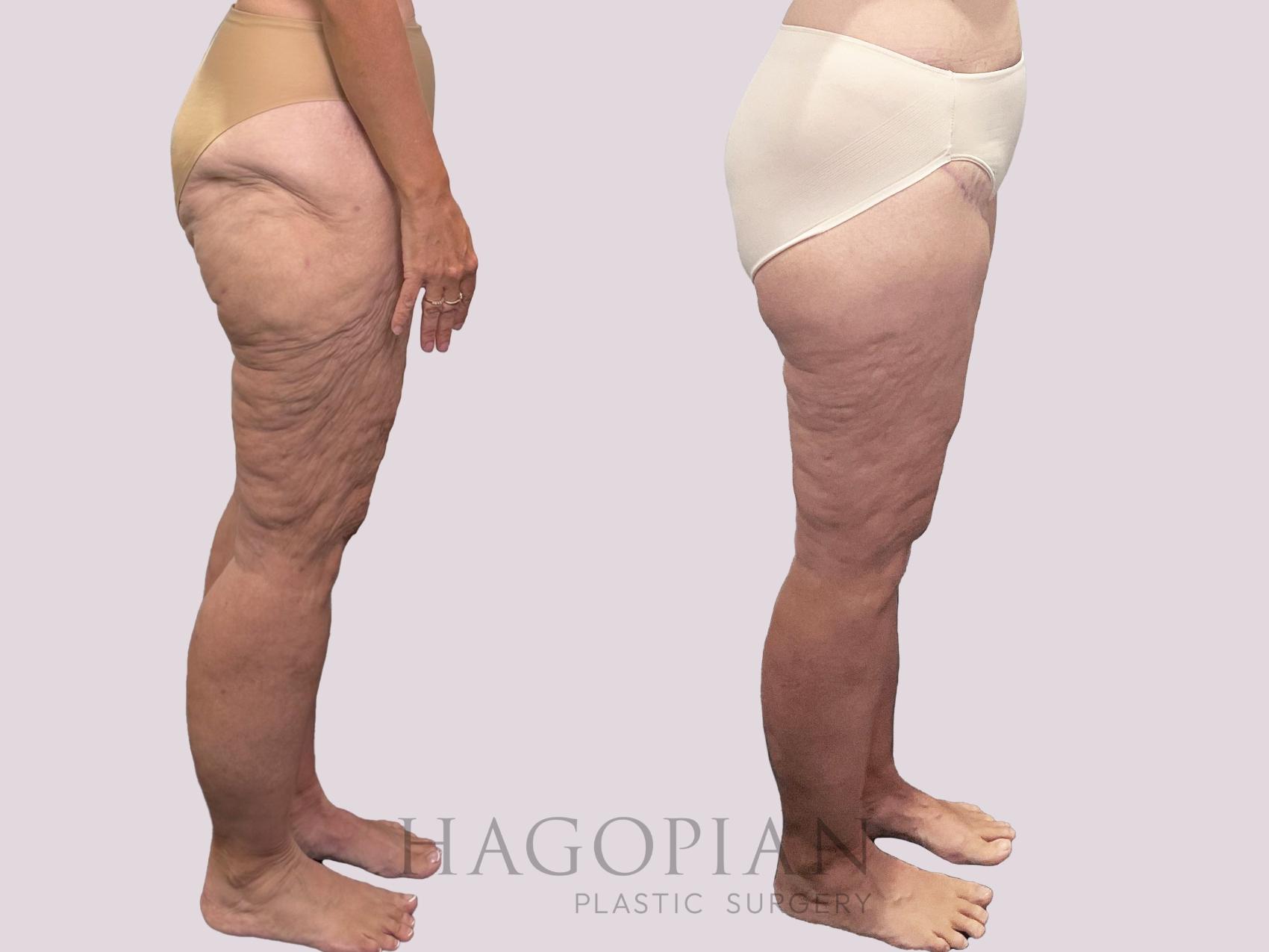Before & After Thigh Lift Case 163 Right Side View in Atlanta, GA