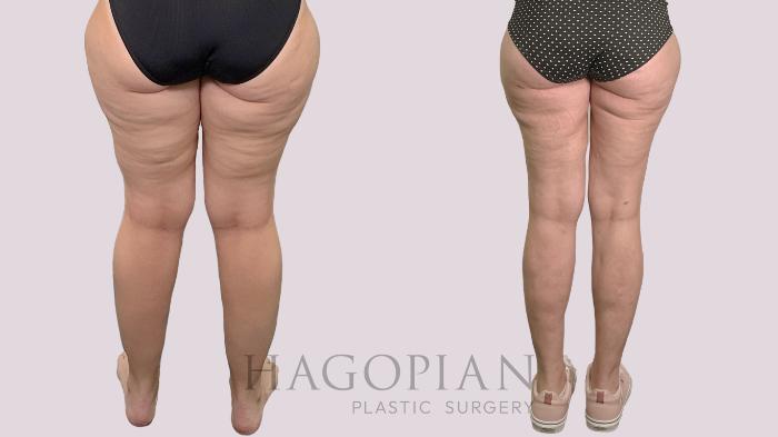 Before & After Thigh Lift Case 175 Back View in Atlanta, GA