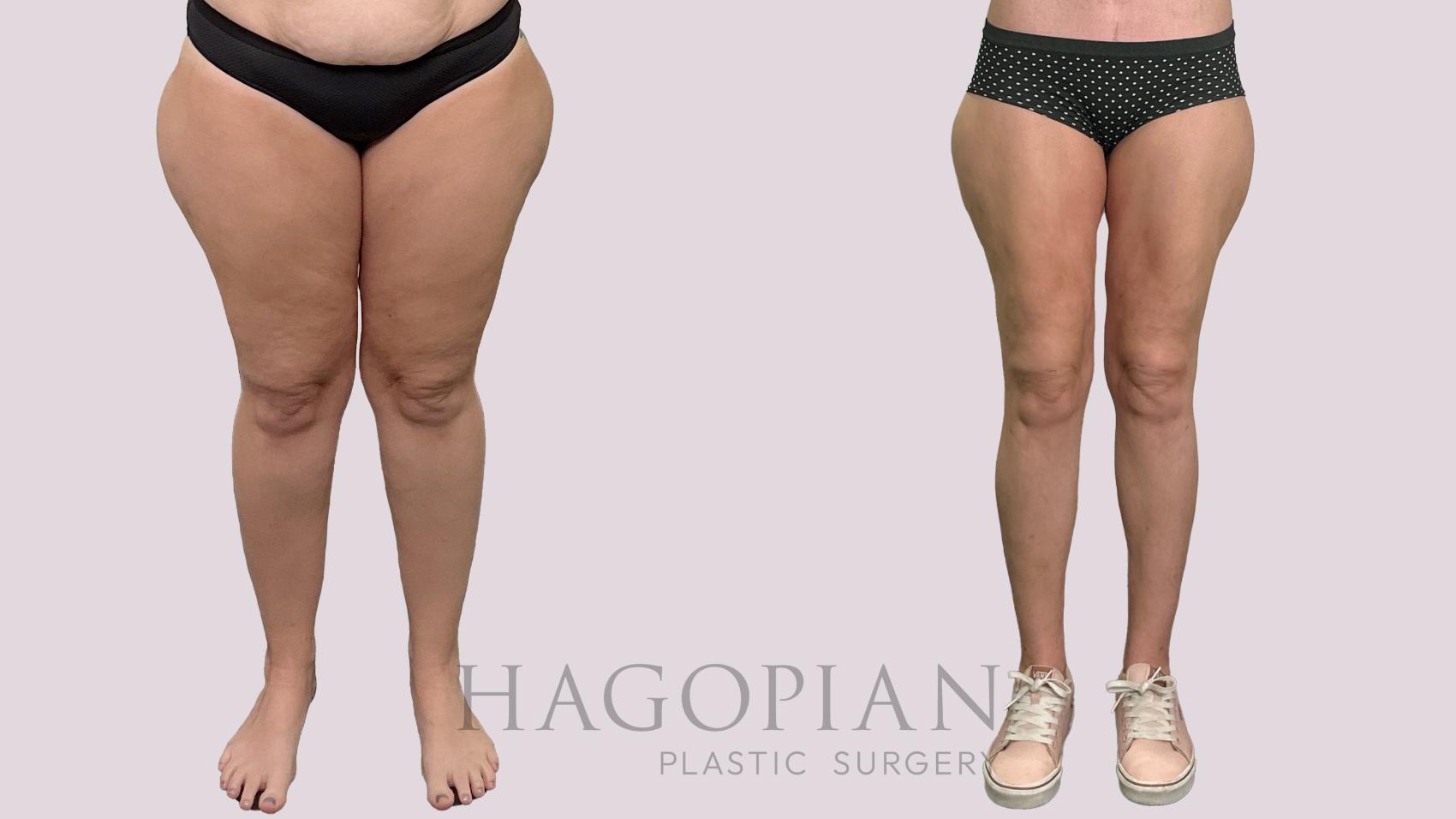 Before & After Thigh Lift Case 175 Front View in Atlanta, GA