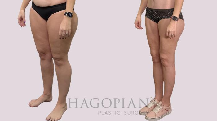 Before & After Thigh Lift Case 175 Left Oblique View in Atlanta, GA