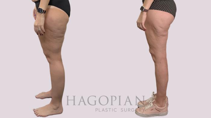 Before & After Thigh Lift Case 175 Left Side View in Atlanta, GA