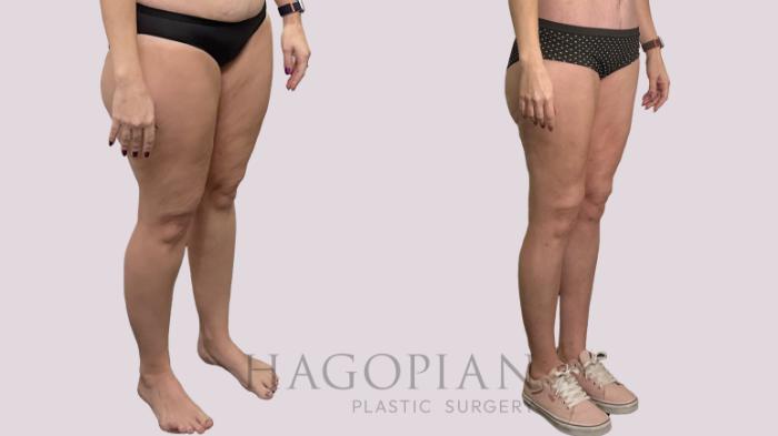 Before & After Thigh Lift Case 175 Right Oblique View in Atlanta, GA