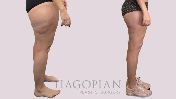 Before & After Thigh Lift Case 175 Right Side View in Atlanta, GA