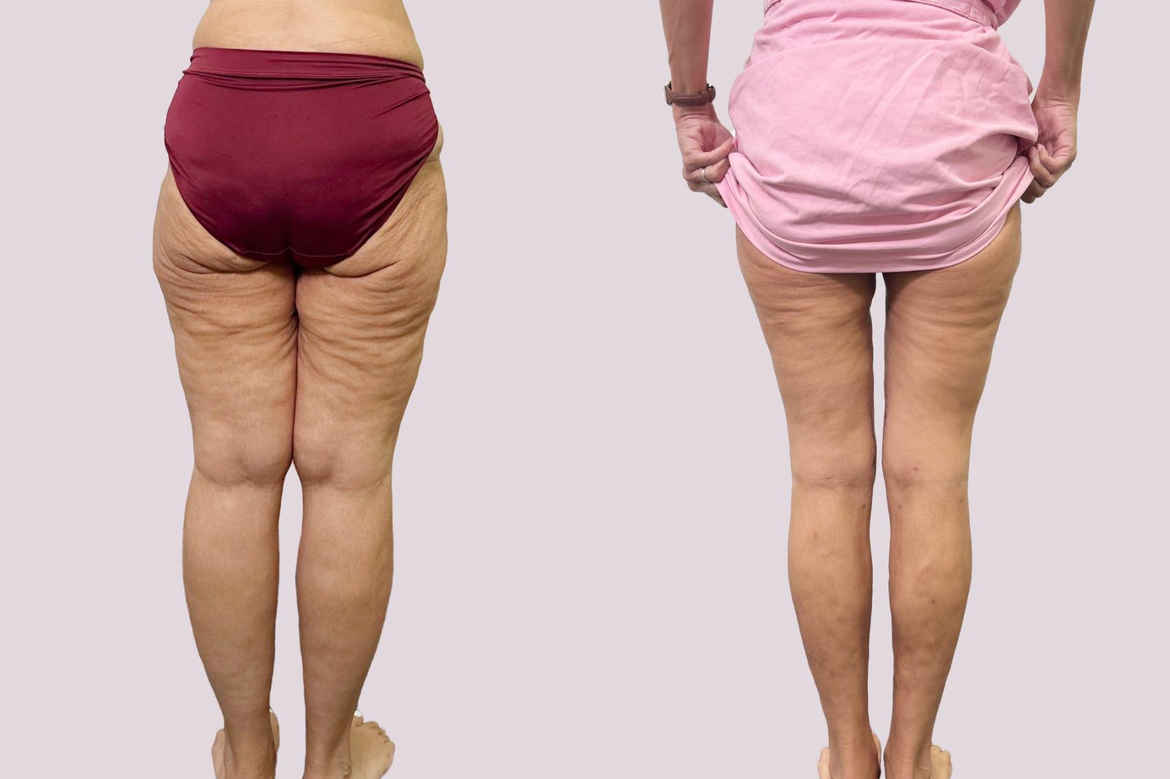 Before & After Lipedema Surgery Case 191 Back View in Atlanta, GA