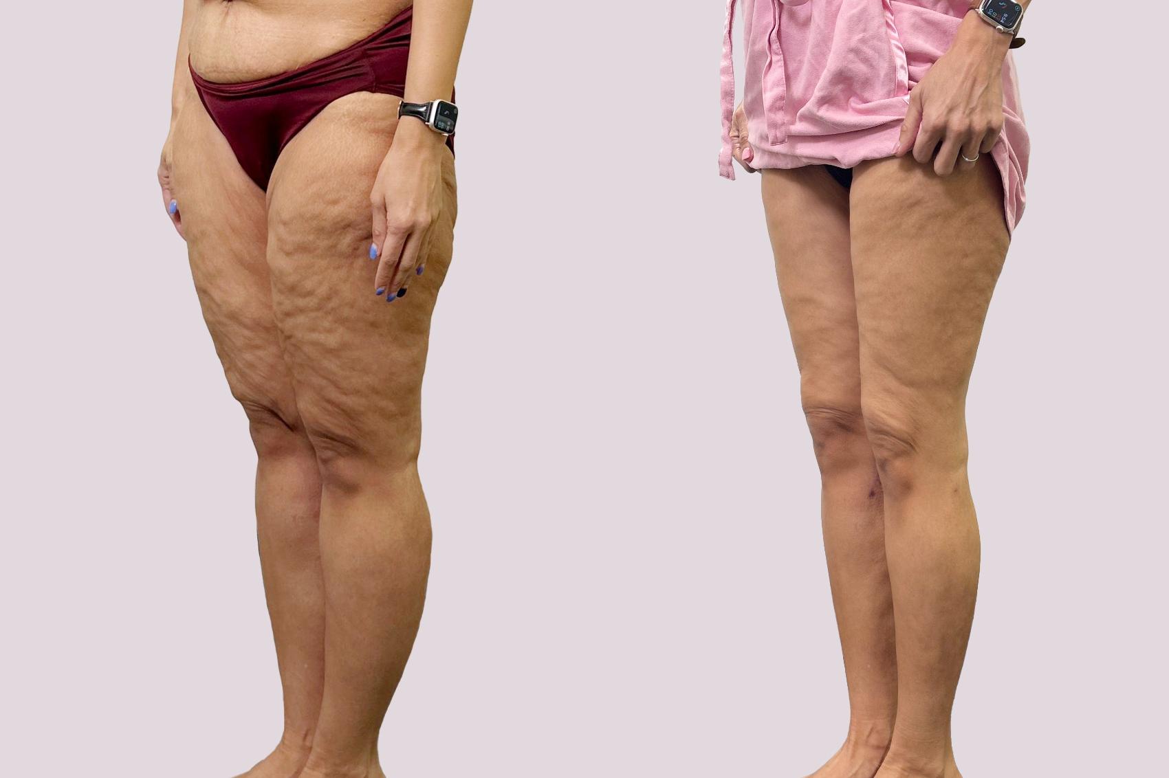 Before & After Lipedema Surgery Case 191 Left Oblique View in Atlanta, GA