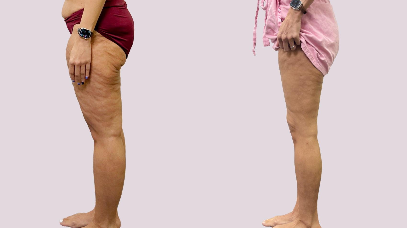 Before & After Lipedema Surgery Case 191 Left Side View in Atlanta, GA