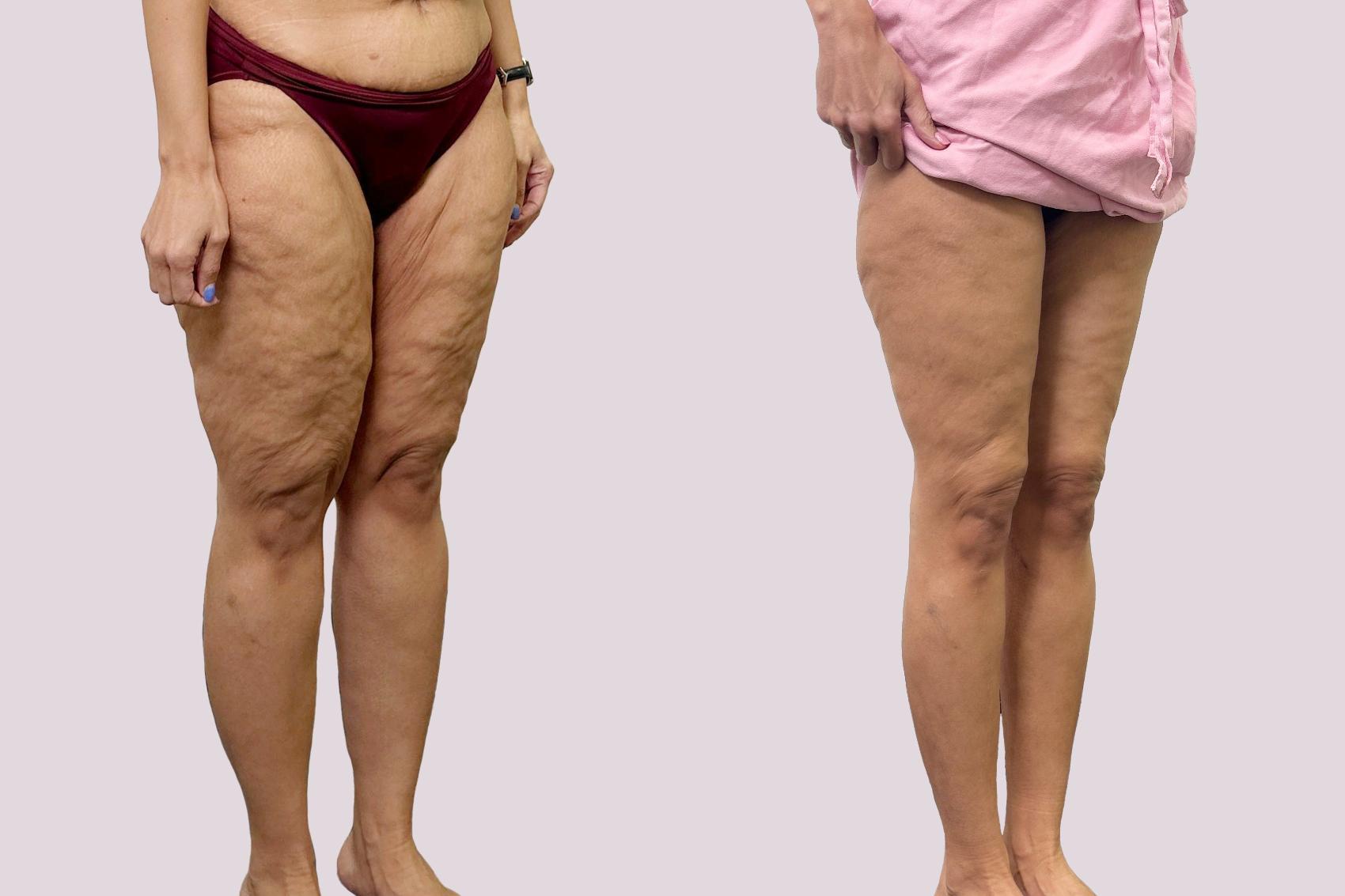 Before & After Lipedema Surgery Case 191 Right Oblique View in Atlanta, GA