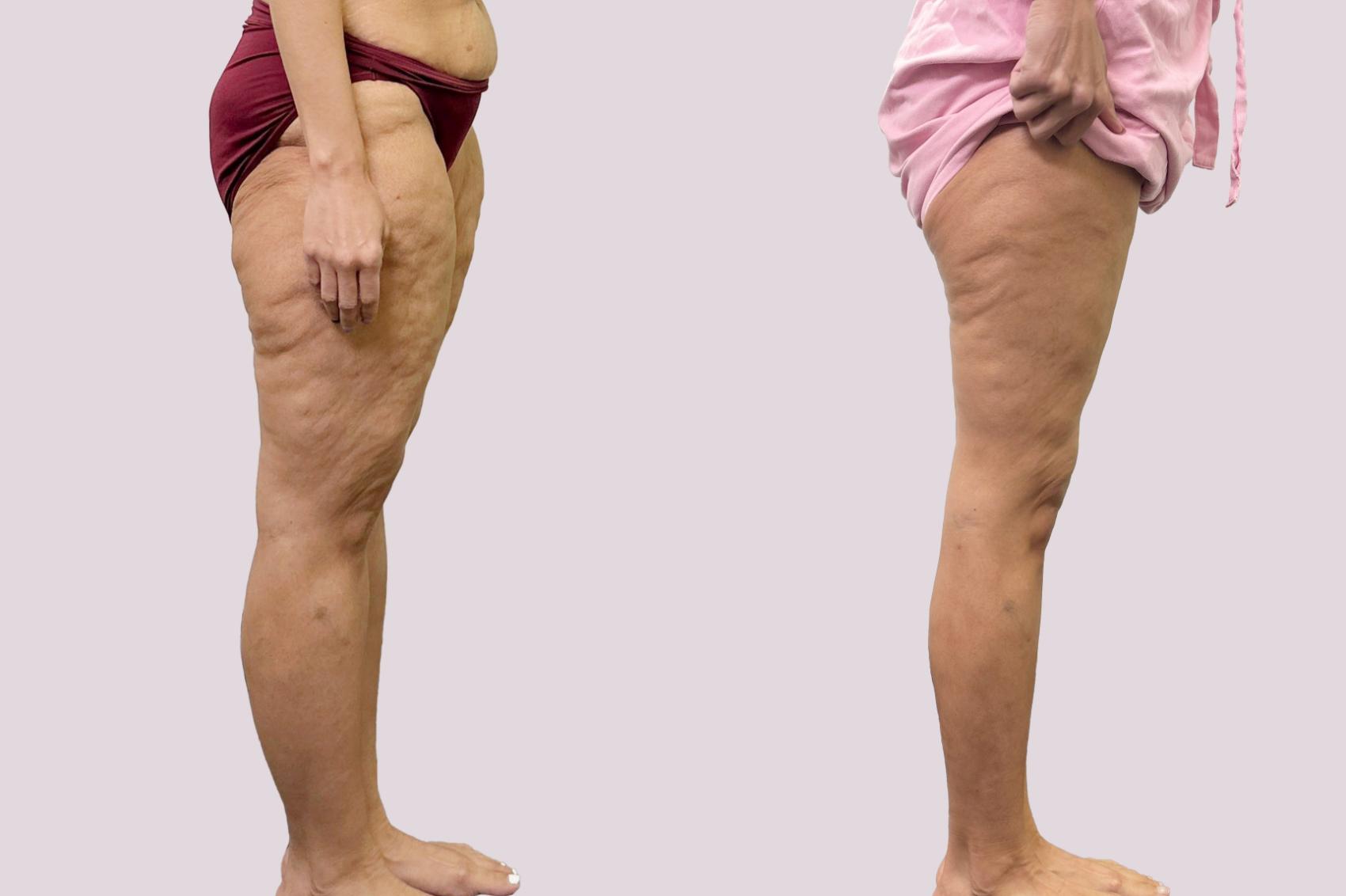 Before & After Lipedema Surgery Case 191 Right Side View in Atlanta, GA