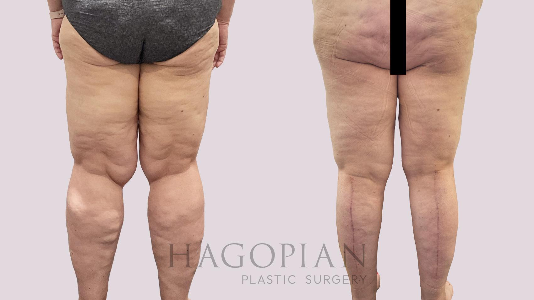 Before & After Thigh Lift Case 194 Back View in Atlanta, GA